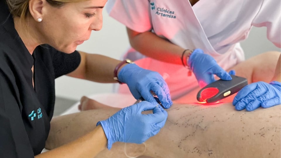 El tratamiento de fleboterapia, una de los opciones para tratar las varices