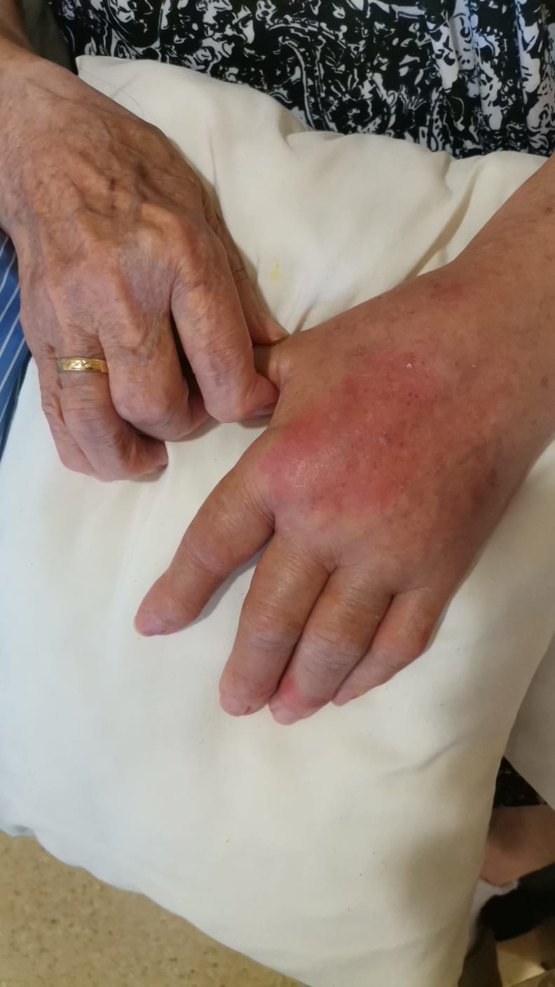 Imagen de una interna que sufrió lesiones por un mal cambio de postura durante la noche