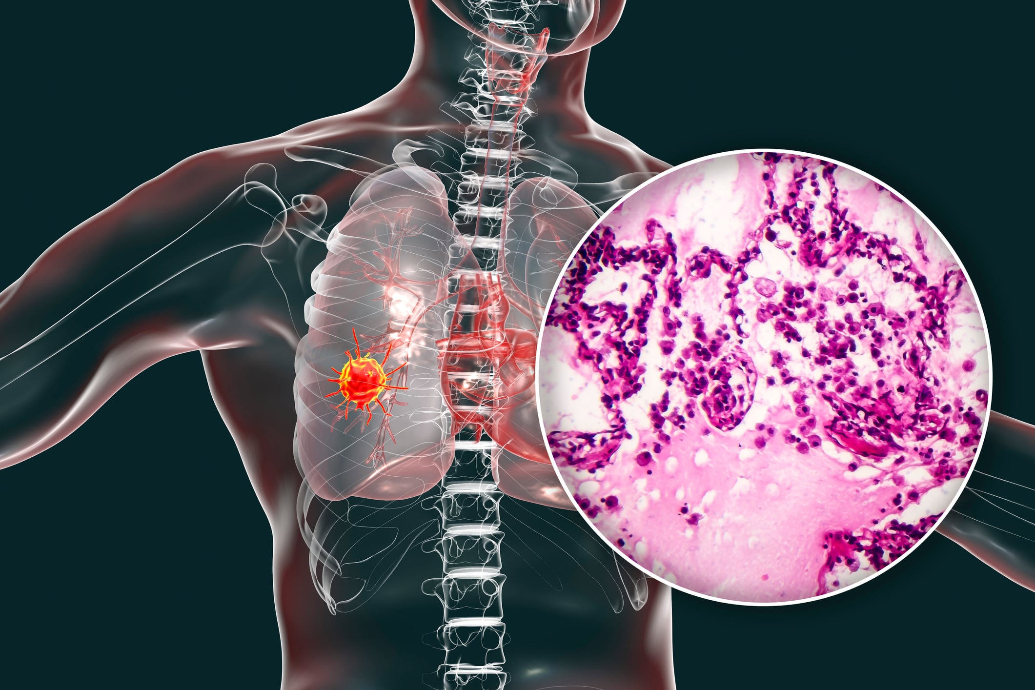 Representación del cáncer de pulmón.