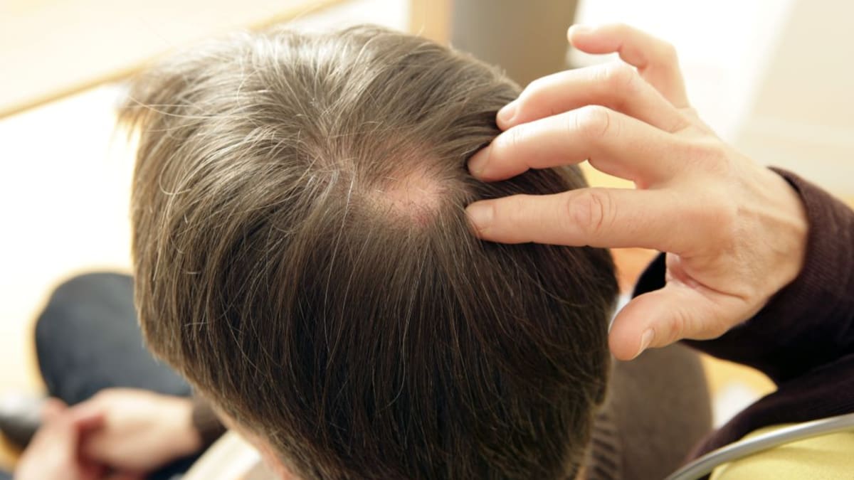 Alimentación para mejorar la caída del cabello