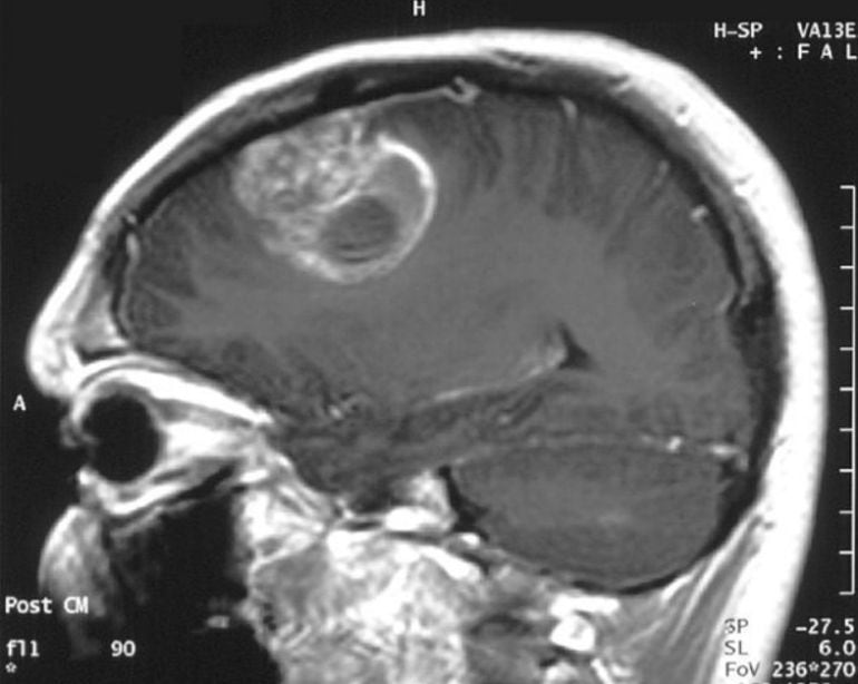 Imagen en la que se puede apreciar un cerebro con un tumor cancerígeno. 