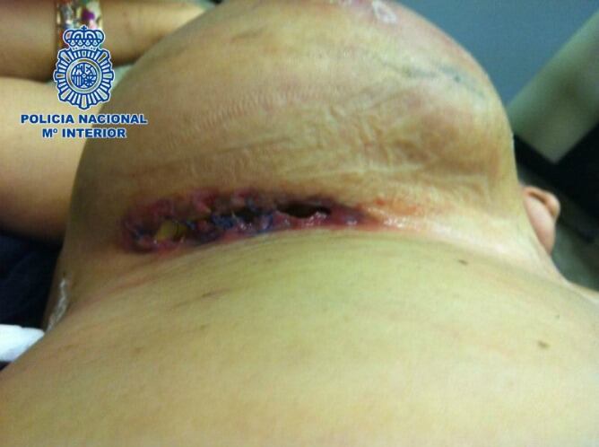 Implantes mamarios de la mujer detenida a su llegada a Madrid.