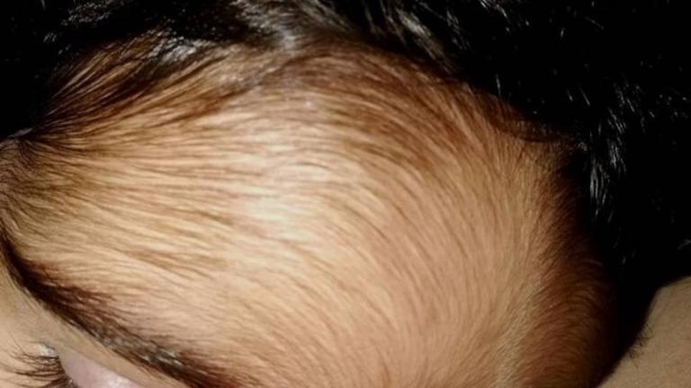 Imagen de una niña afectada por el caso del crecepelo.