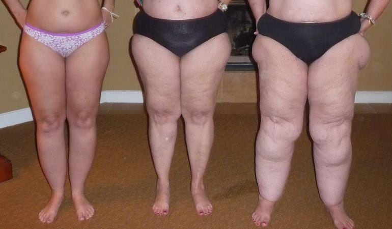 Mujeres que padecen Linfedema
