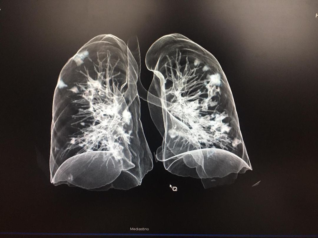 Imagen de la reconstrucción de una radiografía pulmonar en 3D con COVID-19