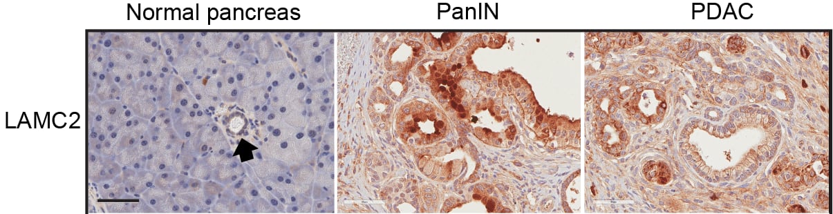 Imagen microscópica del gen LAMC2 (marrón) en tejido de páncreas normal, de tejido preneoplásico pancreático (PanIN) y en tejido tumoral de adenocarcinoma pancreático (PDAC)