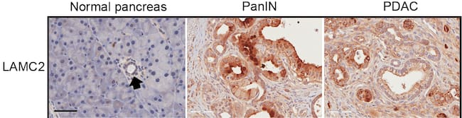 Imagen microscópica del gen LAMC2 (marrón) en tejido de páncreas normal, de tejido preneoplásico pancreático (PanIN) y en tejido tumoral de adenocarcinoma pancreático (PDAC)