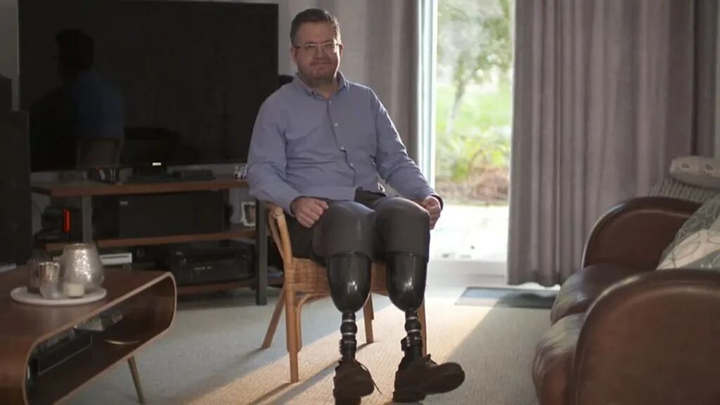 Neil Hopper tras la amputación de sus dos piernas