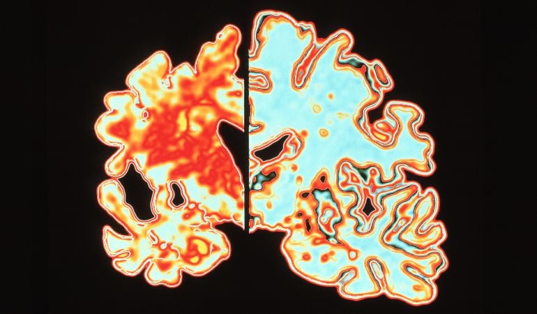 Un cerebro afectado por el alzhéimer (izquierda) y otro sano (derecha).