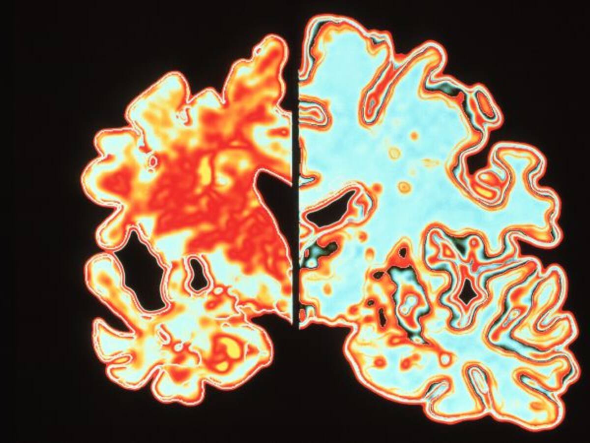 Detectan una de las claves para detener y revertir el párkinson y el alzhéimer