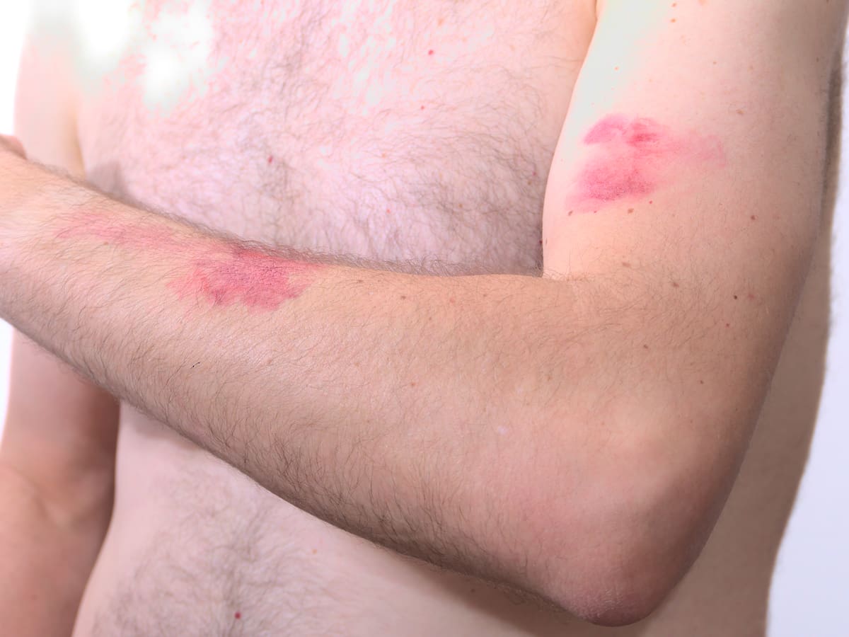 “En este momento no podemos hablar de pandemia de viruela del mono”: Octavio Arce, médico especialista en enfermedades infecciosas