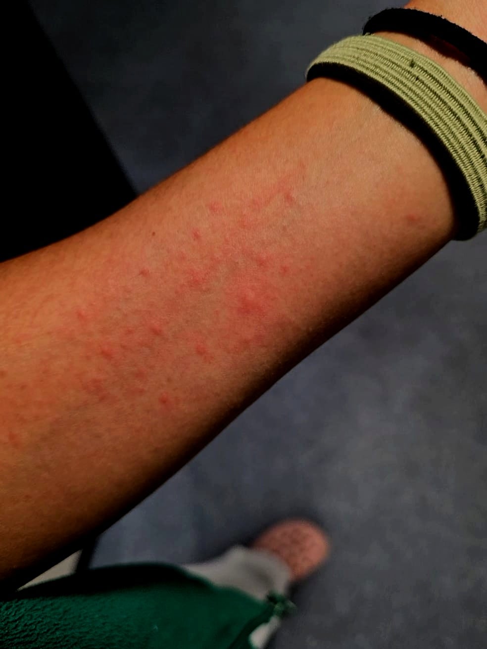 Sintomatología causada en el brazo por la intoxicación en el Laboratorio de Anatomía Patológica del Hospital Universitario de Toledo