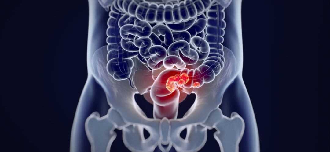 Imagen de cáncer colorrectal