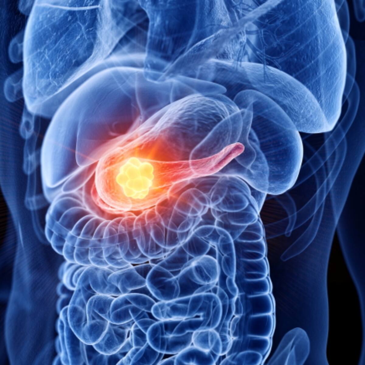 Una investigadora del cáncer de páncreas reivindica la financiación para aumentar la supervivencia: los datos hablan por sí solos