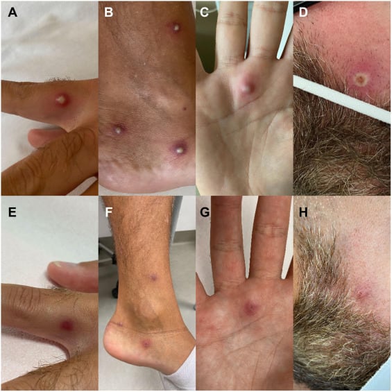 Lesiones cutáneas sufridas por el paciente.