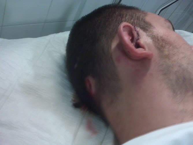 En la imagen uno de los integrantes del Club Atlético Rosario Central de Cataluña que sufre una fisura en la costilla, la oreja derecha casi desprendida por lo que le han tenido que dar diez puntos de sutura y le tienen que hacer pruebas en el oído porque podría haber perdido audición.