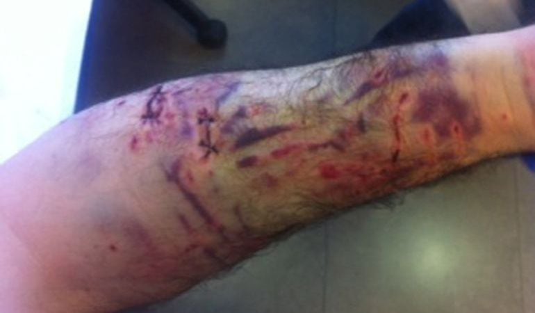 Las heridas en brazos y piernas requieren de curas diarias