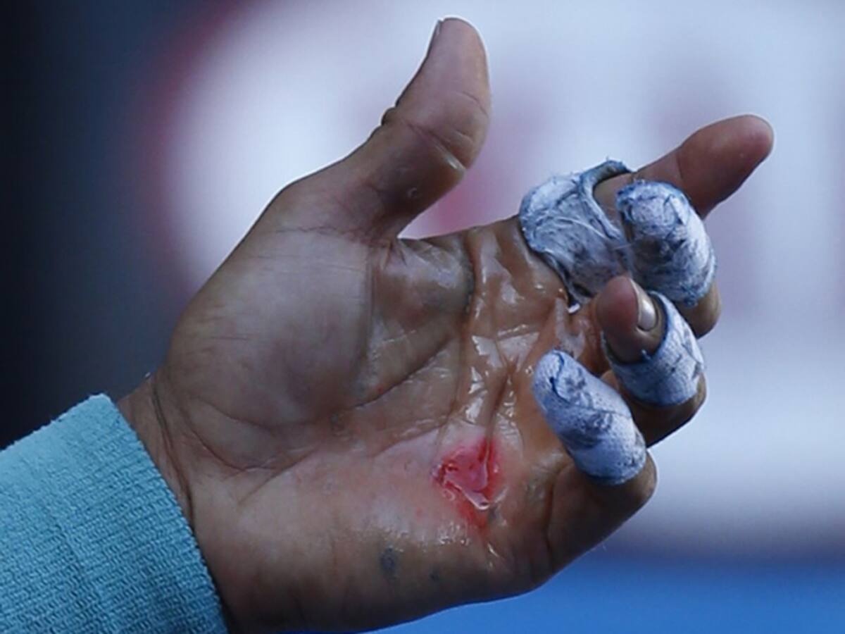Nadal asegura que su herida está perjudicando a su servicio