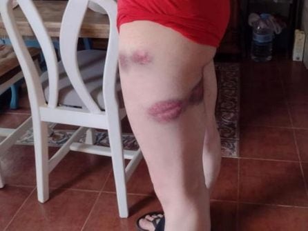 Imagen de las heridas que sufre el joven