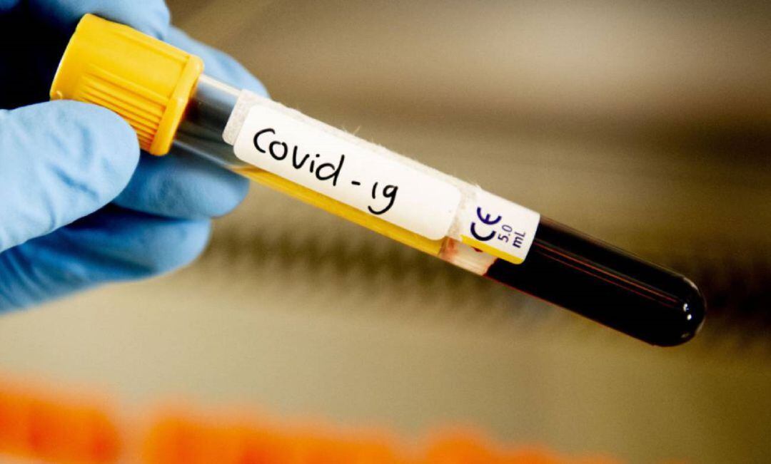 Una muestra de Covid-19