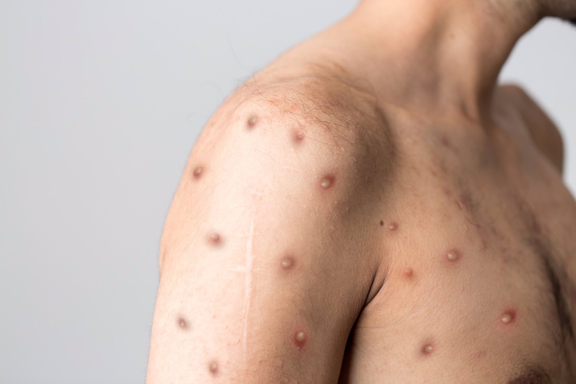 Lesiones provocadas por la mpox. - ISTOCK