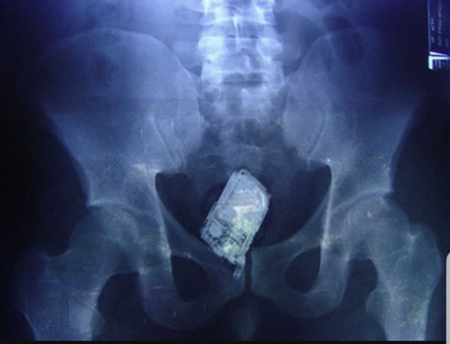 Teléfono móvil dentro del cuerpo de un recluso.