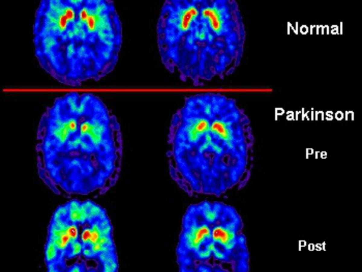 Parkinson, difícil de diagnosticar
