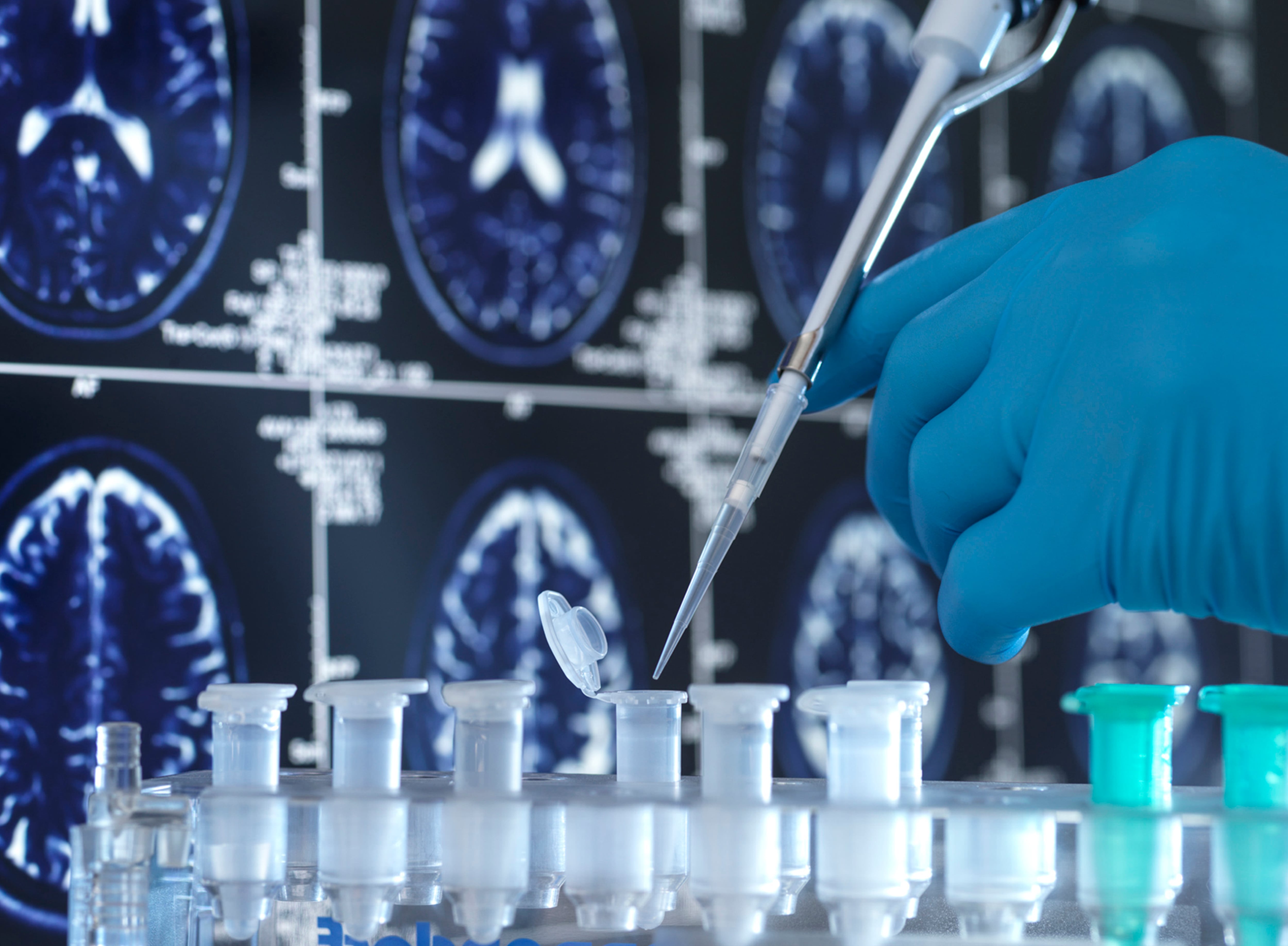 La investigación en torno al alzhéimer es primordial.