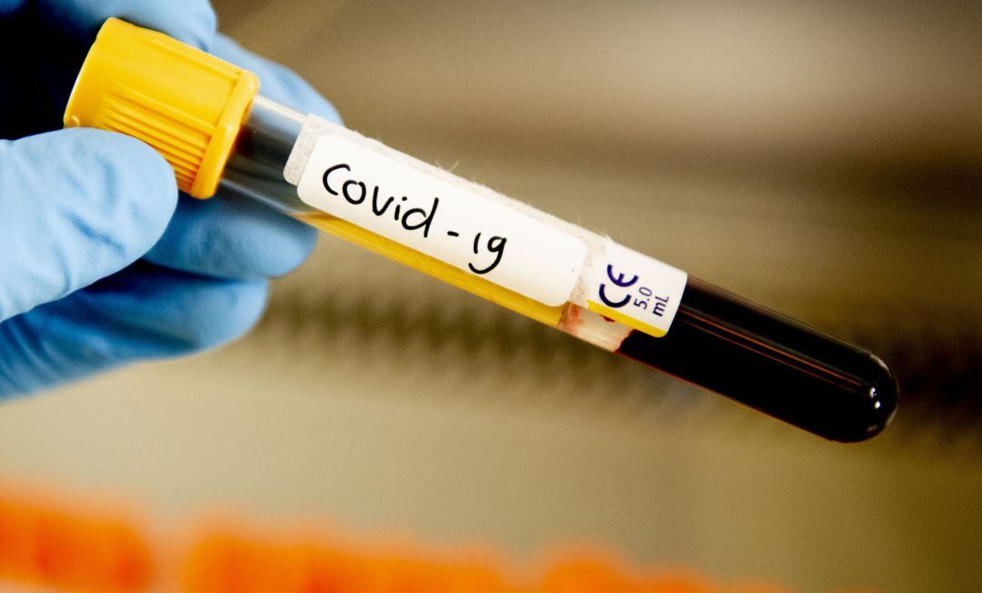 Muestra de coronavirus.