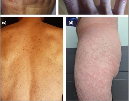 Problemas en la piel asociados al coronavirus.