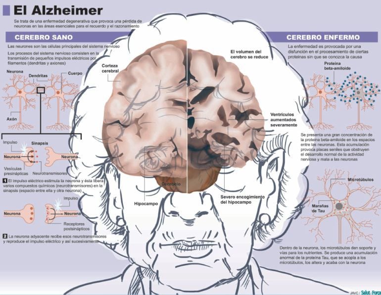 Este gráfico muestra las diferencias entre un cerebro sano y otro afectado por la muerte neuronal que provoca la enfermedad de alzhéimer. 