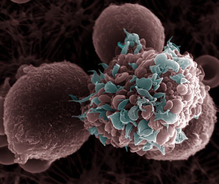 Célula tumoral rodeada de plaquetas.