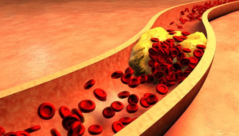 Los niveles altos del llamado colesterol &quot;malo&quot; taponan las arterias y pueden causar un buen número de enfermedades cardiovasculares. 