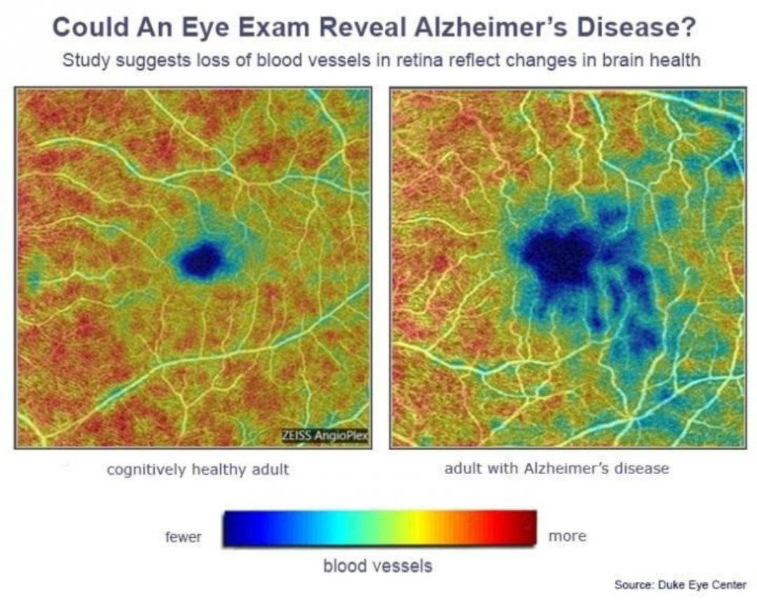 Un oftalmólogo podría en un futuro diagnosticar la enfermedad de Alzheimer antes de que aparezcan síntomas.