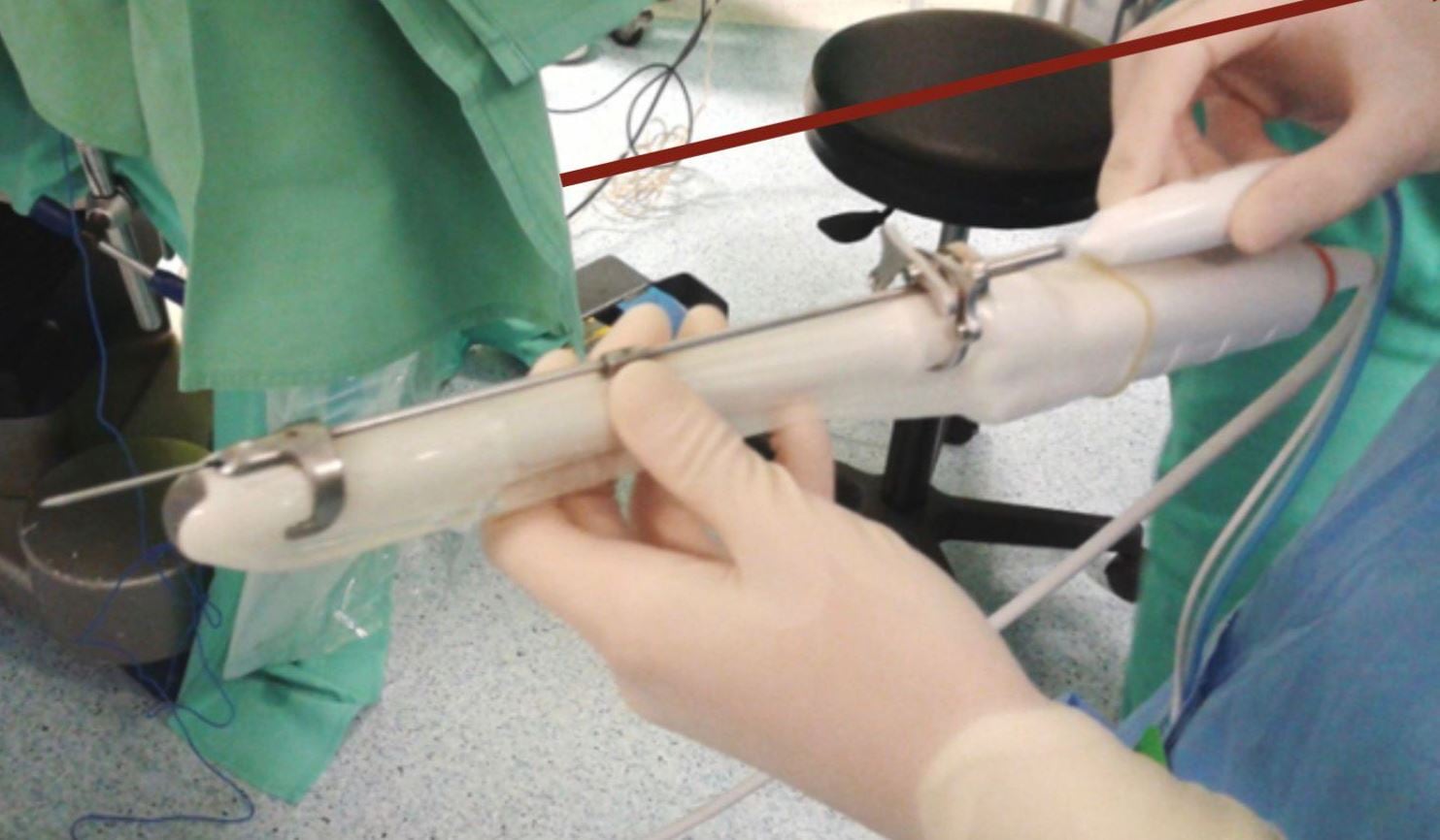 Tratamiento de mioma con radiofrecuencia.