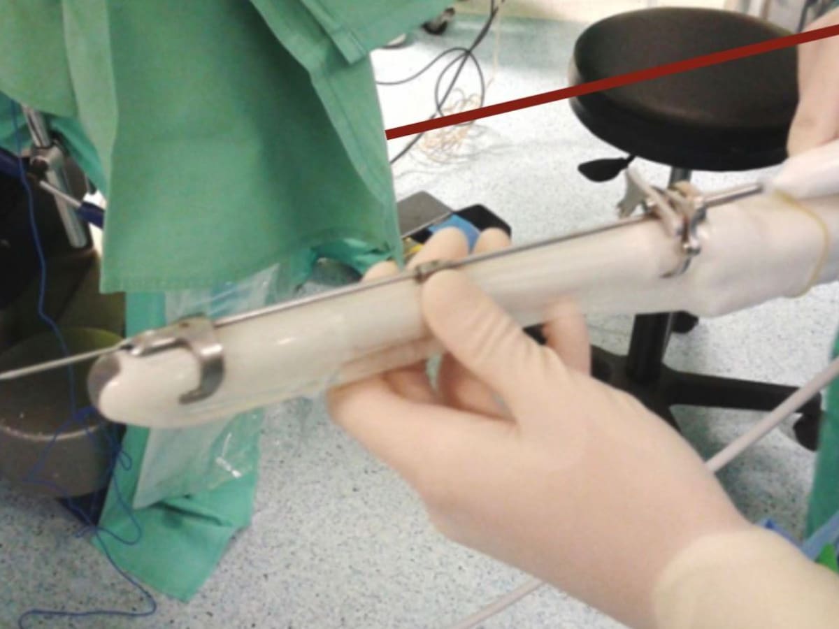 El Hospital de Gandia incorpora el tratamiento de radiofrecuencia para miomas ginecológicos