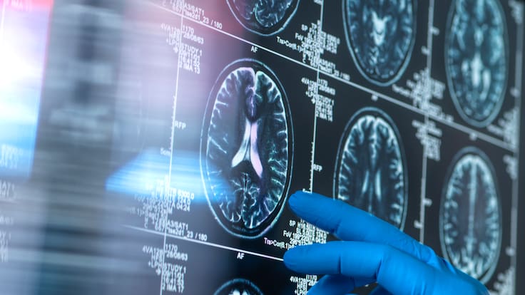 La Diputación aprueba un servicio pionero para la prevención, detección temprana y atención del alzhéimer