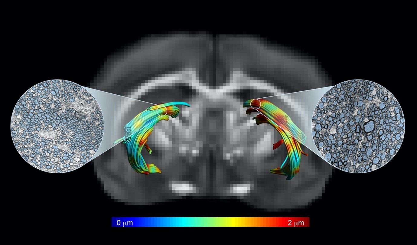 Imagen de resonancia magnética en que se han reconstruido dos tractos de la materia blanca cerebral, uno con daño axonal (dcha.) y otro sano (izda.). Los tractos están coloreados según el diámetro axonal medido con resonancia de forma no invasiva. Se ha comprobado el tamaño axonal a través de técnicas de microscopia electrónica (en azul). IN-CSICUMH.