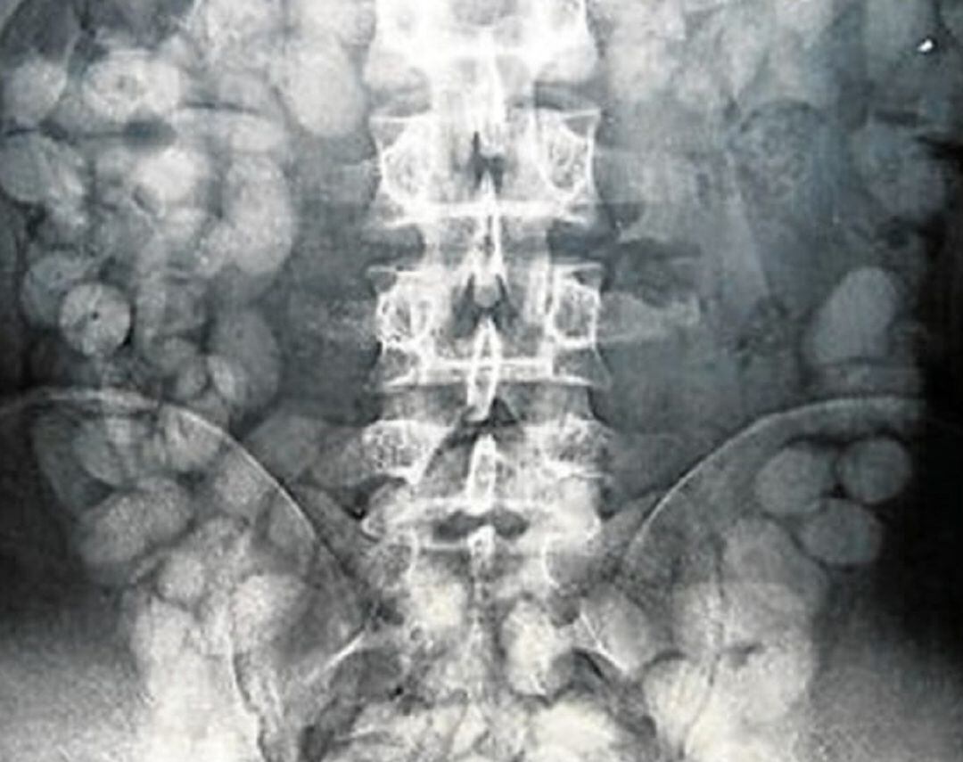 Radiografía de un interno con droga en el interior de sus organismo