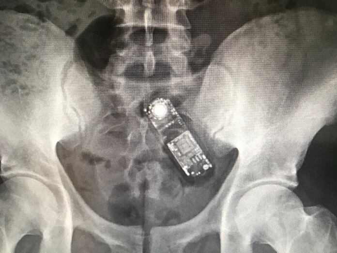 Radiografía de un preso con un móvil en su interior