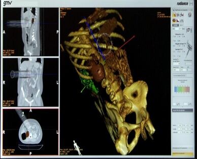 Imagen del primer simulador mundial de cirugía virtual oncológica impulsado por el Hospital Gregorio Marañón