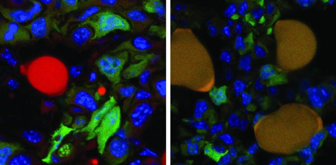 Células cancerosas antes y después del tratamiento. 
 
 
 