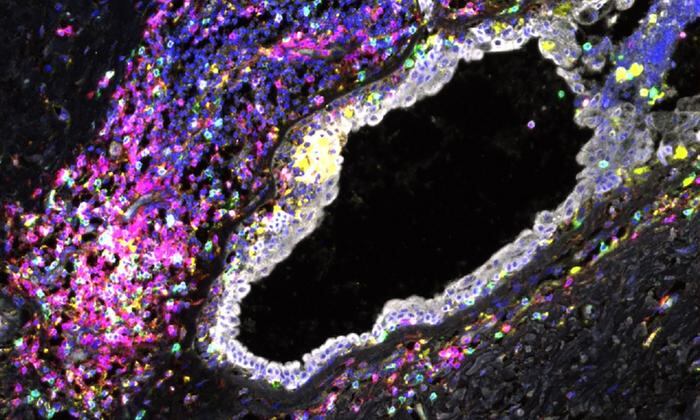 El agotamiento de las células inmunitarias se observa en el tejido mamario de portadores de mutaciones en BRCA1 y BRCA2 mucho antes de que se desarrolle el cáncer de mama. CRÉDITO
Sara Pensa/Universidad de Cambridge