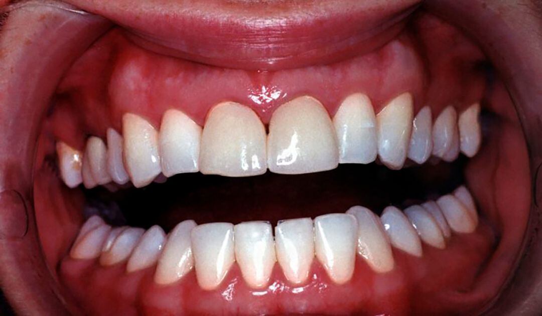 Dentadura con problemas de encías