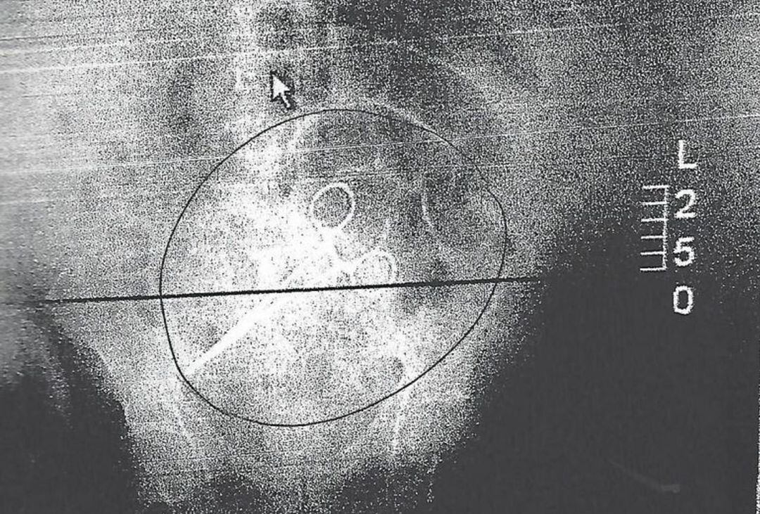 En la radiografía se puede observar las tijeras alojadas en el interior del paciente