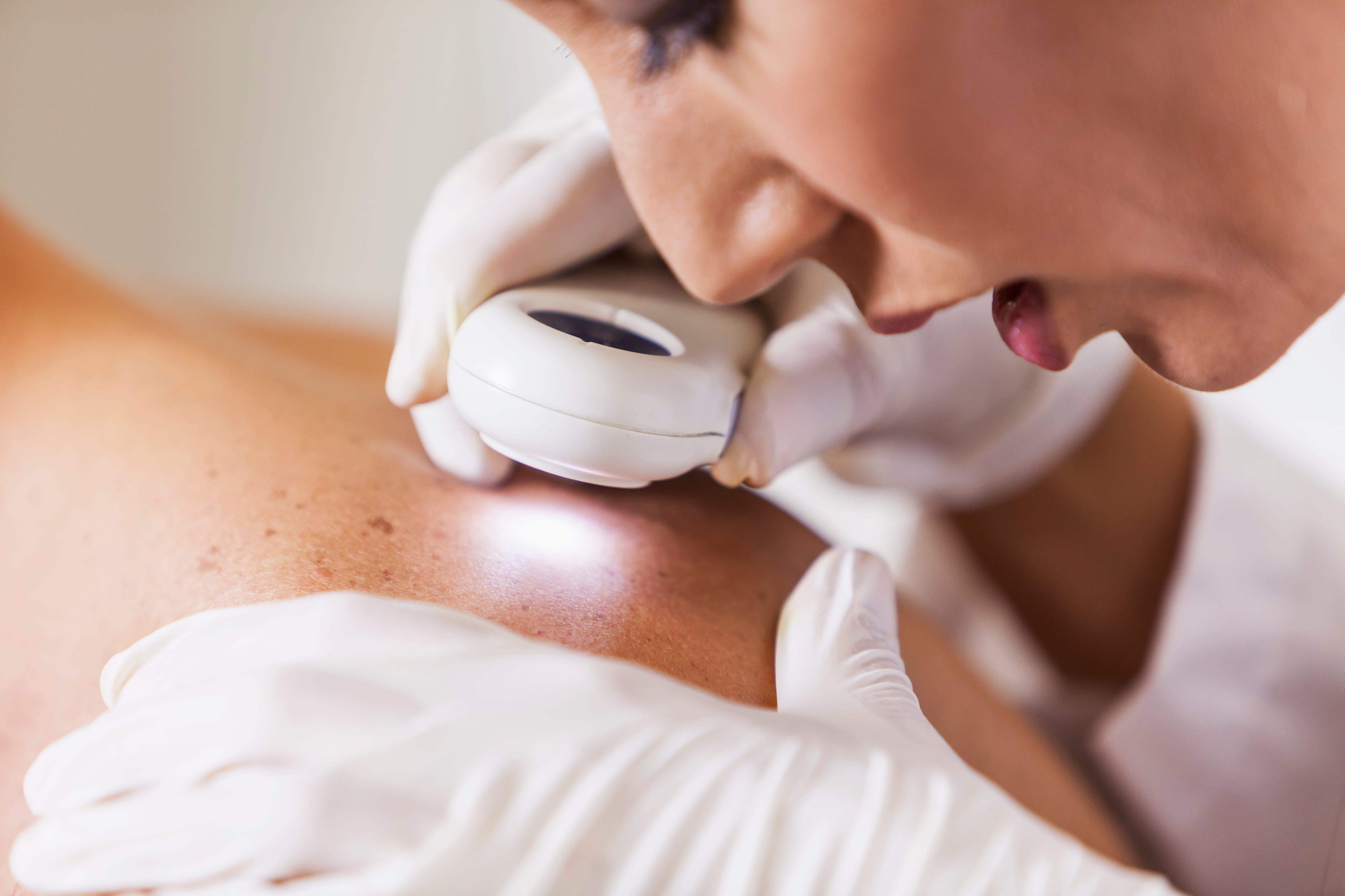 Female dermatologist (30s) examining male patient&#039;s skin with dermascope, carefully looking at a mole for signs of skin cancer.