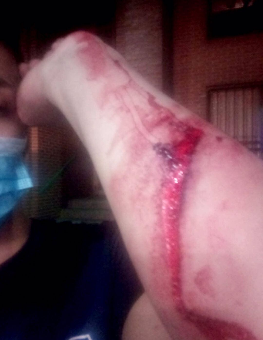 Imagen de la herida producida con el hacha