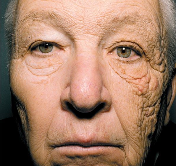 Bill McElligott fue camionero durante 28 años y en su rostro se reflejaban el tiempo que el sol le había dado solo en un lado de la cara sin utilizar protección