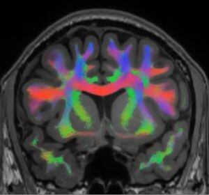 Escáner cerebral, extraído del estudio.