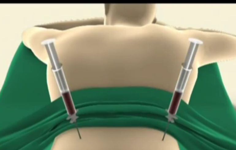 Simulació d'extracció de medul·la